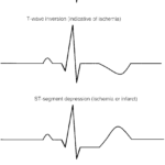 Example Of 1 Normal (Isoelectric) Ecg Tracing And 3 Abnormal